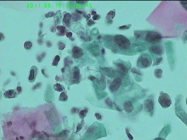 LCT再来一例图13