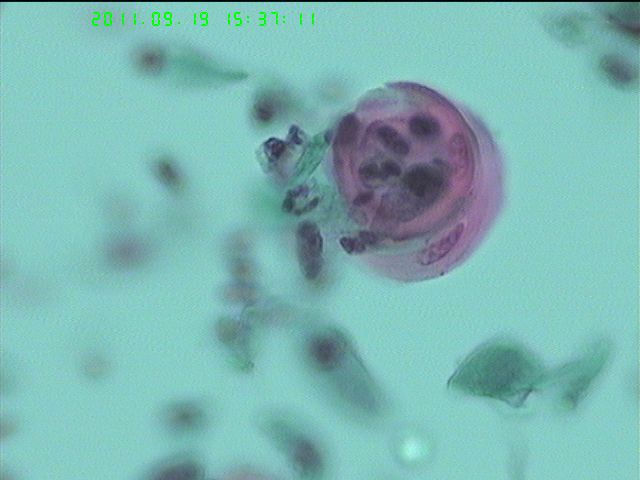 LCT再来一例图14