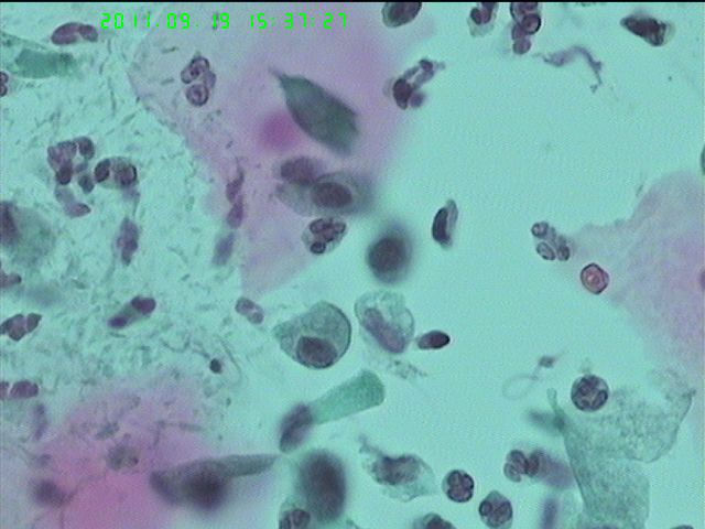 LCT再来一例图16