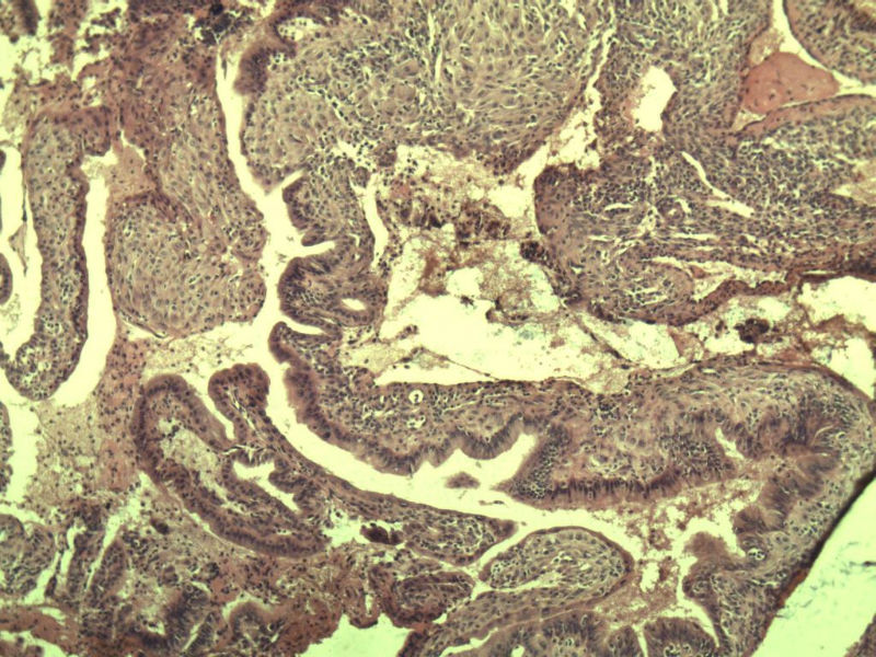 子宫内膜癌?? 会诊结果出了图6