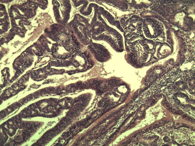 子宫内膜癌?? 会诊结果出了图9