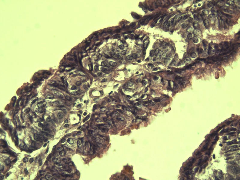 子宫内膜癌?? 会诊结果出了图13