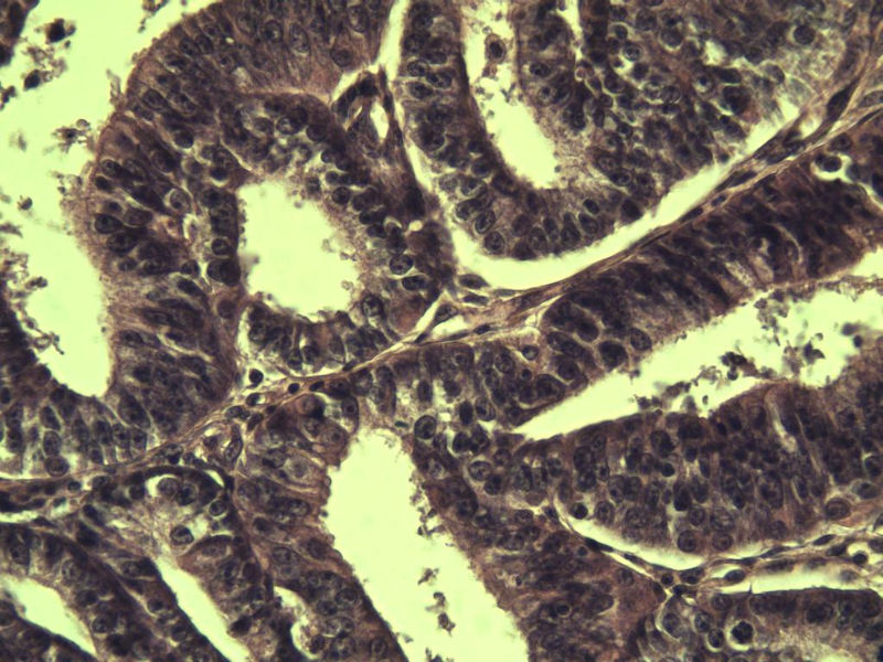 子宫内膜癌?? 会诊结果出了图18