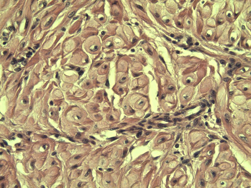 子宫内膜癌?? 会诊结果出了图26