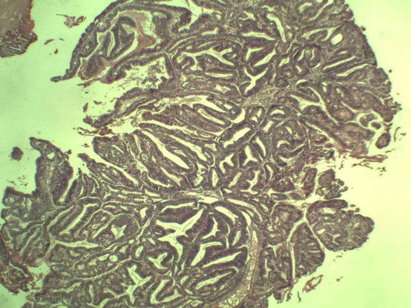 子宫内膜癌?? 会诊结果出了图27
