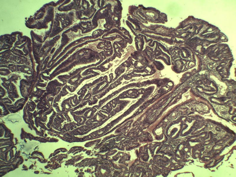 子宫内膜癌?? 会诊结果出了图28