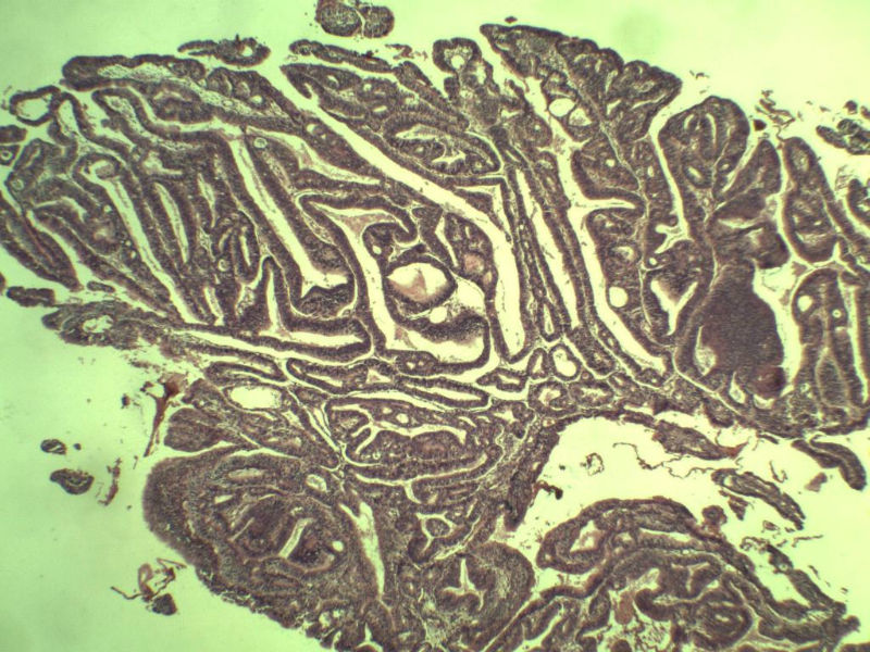 子宫内膜癌?? 会诊结果出了图29