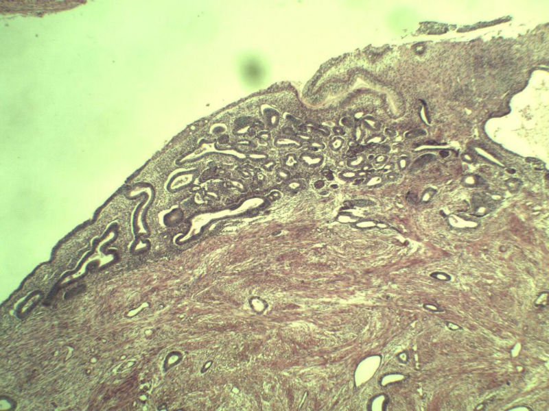 子宫颈管上段图1