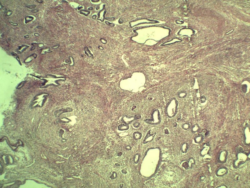 子宫颈管上段图3
