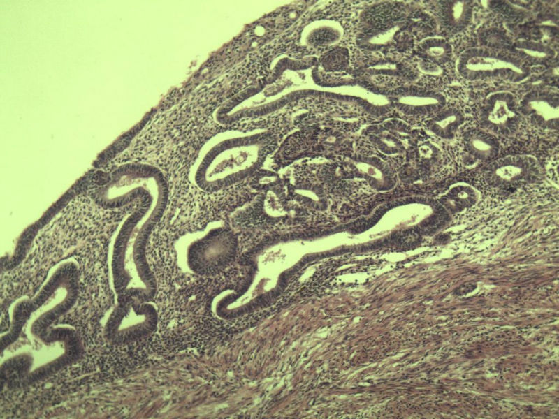 子宫颈管上段图6