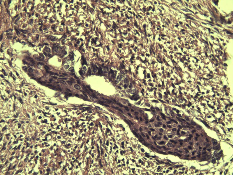 子宫颈管上段图11