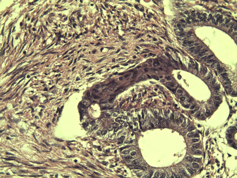 子宫颈管上段图12