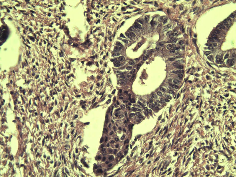 子宫颈管上段图13