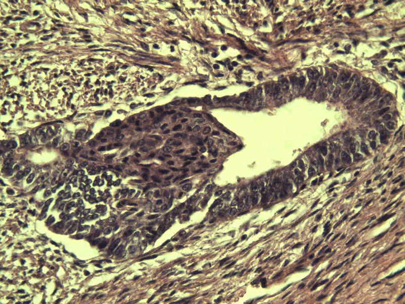 子宫颈管上段图17