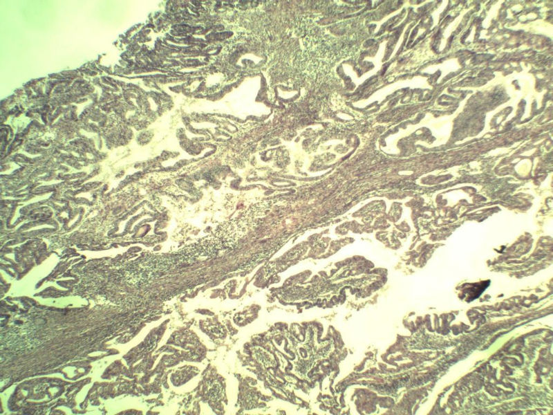 宫颈宫腔积液 内膜癌?图4 宫颈宫腔积液 内膜癌?图4