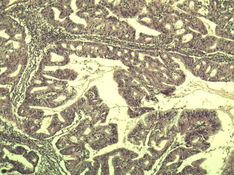 宫颈宫腔积液 内膜癌?图9 宫颈宫腔积液 内膜癌?图9