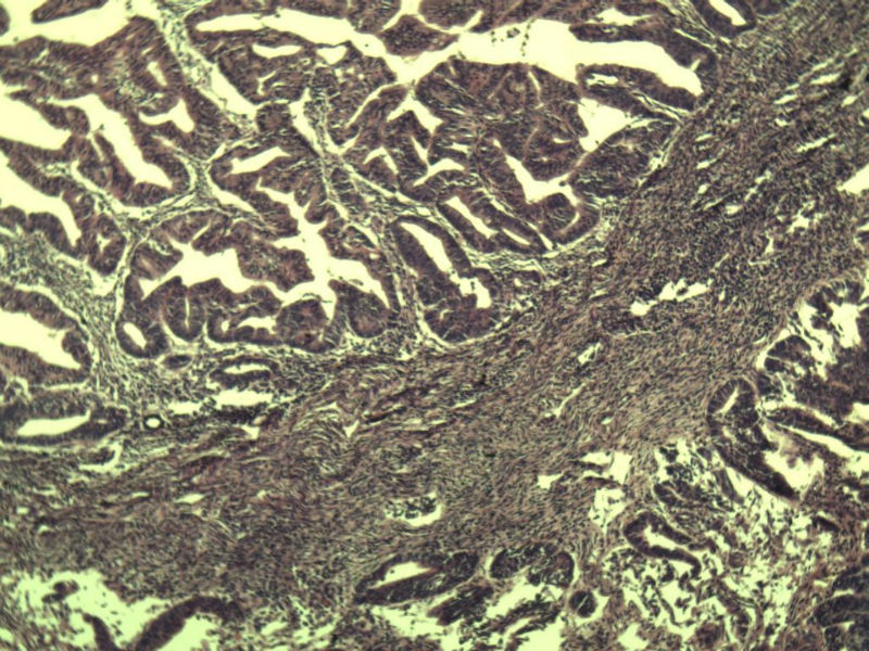 宫颈宫腔积液 内膜癌?图11 宫颈宫腔积液 内膜癌?图11