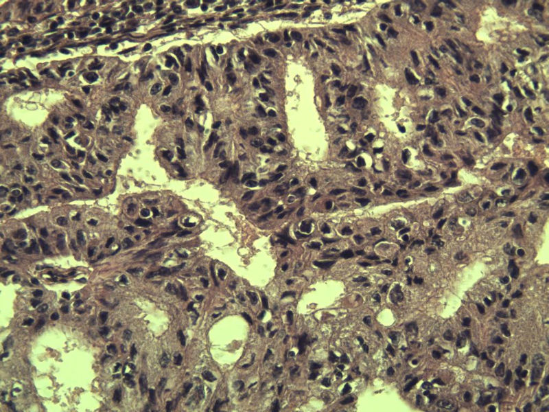 宫颈宫腔积液 内膜癌?图16 宫颈宫腔积液 内膜癌?图16