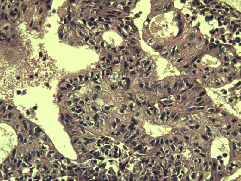宫颈宫腔积液 内膜癌?图17 宫颈宫腔积液 内膜癌?图17