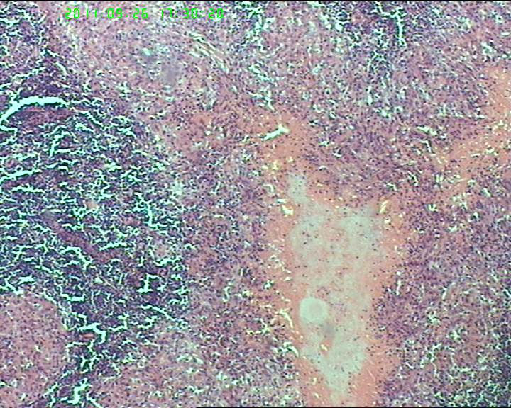 21岁女性左侧颌下淋巴结，该诊断什么？图5