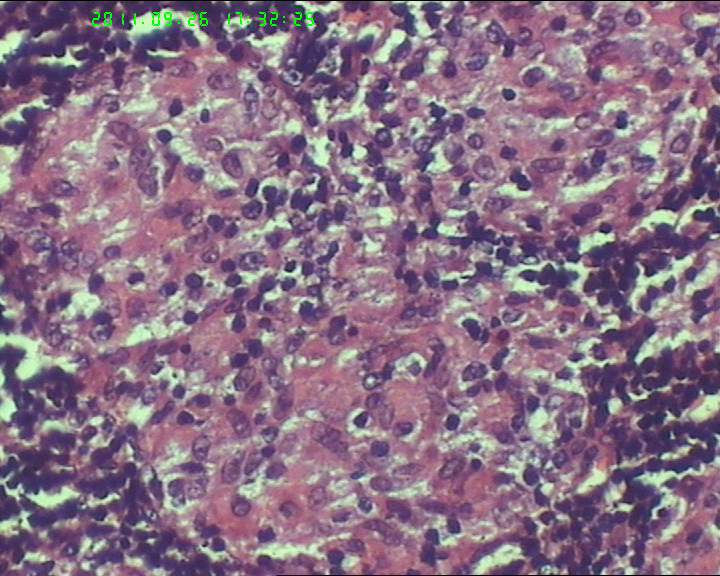 21岁女性左侧颌下淋巴结，该诊断什么？图14