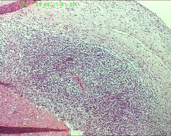 74岁女性盆腔包块，肉瘤？图1