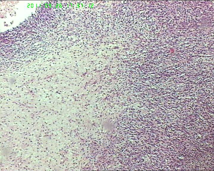 74岁女性盆腔包块，肉瘤？图2