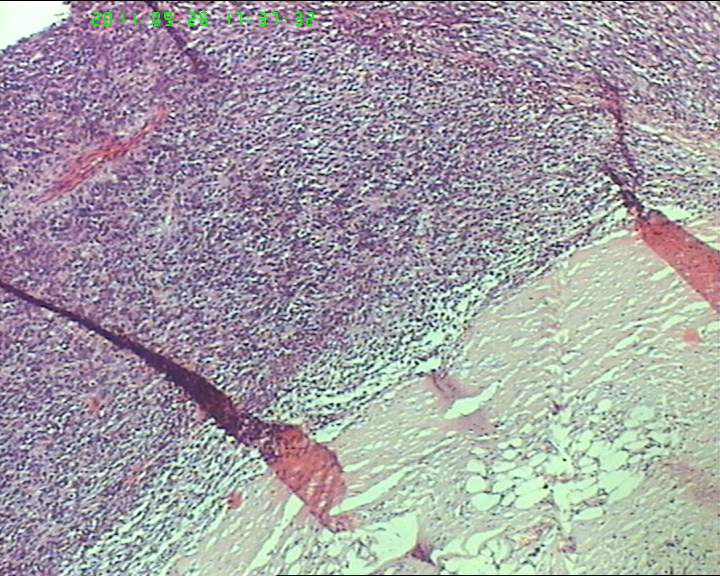 74岁女性盆腔包块，肉瘤？图3