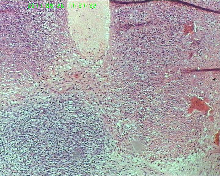 74岁女性盆腔包块，肉瘤？图4