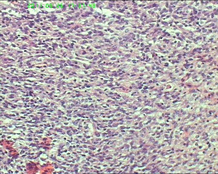 74岁女性盆腔包块，肉瘤？图5