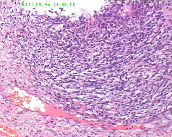 74岁女性盆腔包块，肉瘤？图6