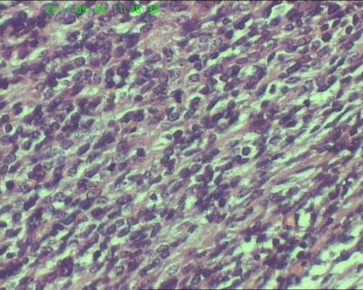 74岁女性盆腔包块，肉瘤？图7