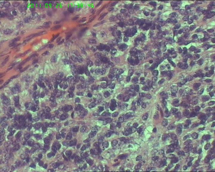 74岁女性盆腔包块，肉瘤？图8