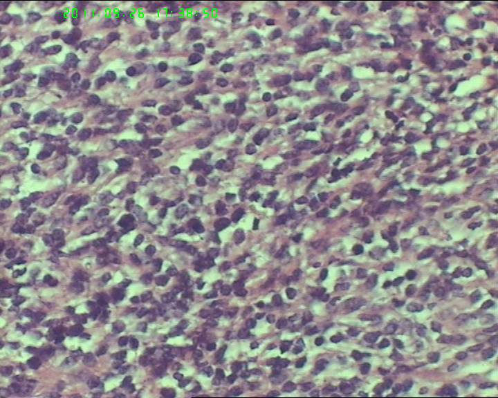 74岁女性盆腔包块，肉瘤？图9