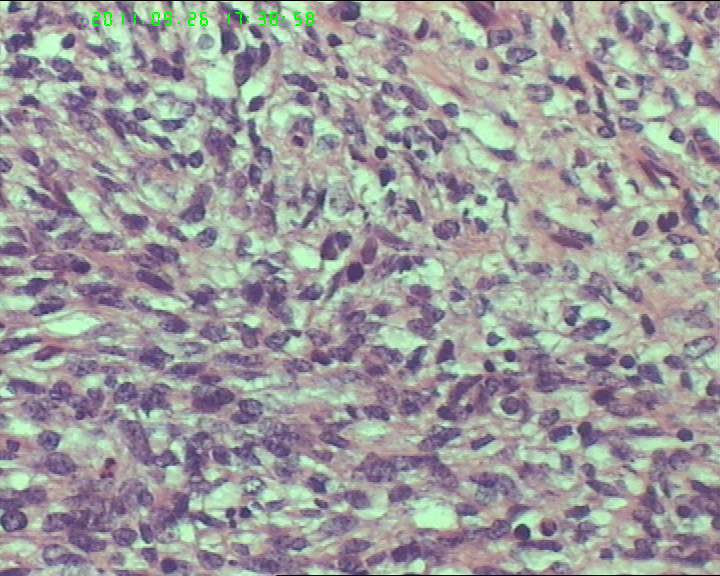 74岁女性盆腔包块，肉瘤？图10