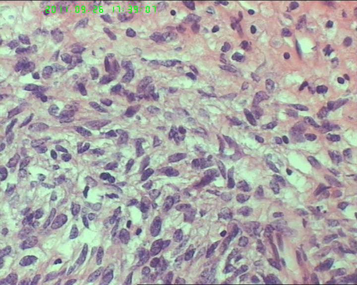 74岁女性盆腔包块，肉瘤？图11