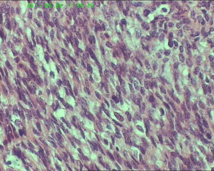 74岁女性盆腔包块，肉瘤？图12