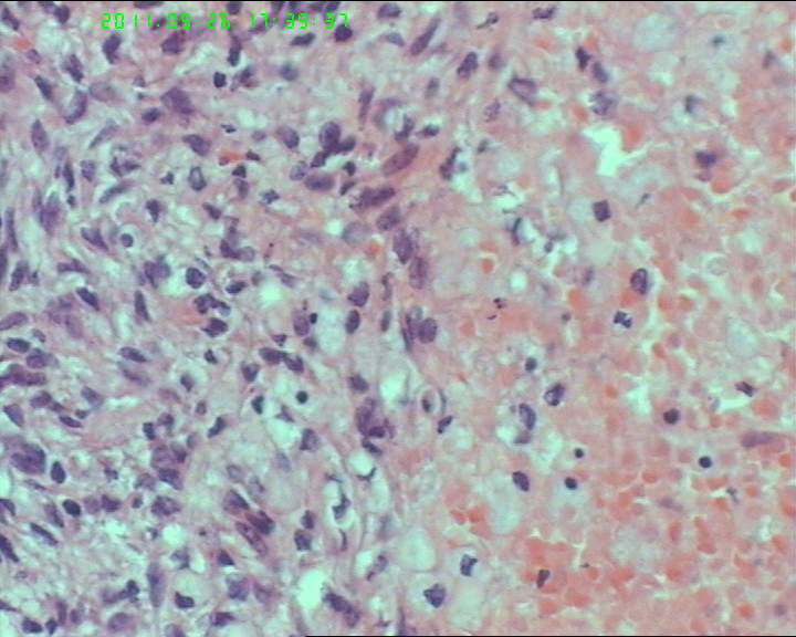 74岁女性盆腔包块，肉瘤？图13