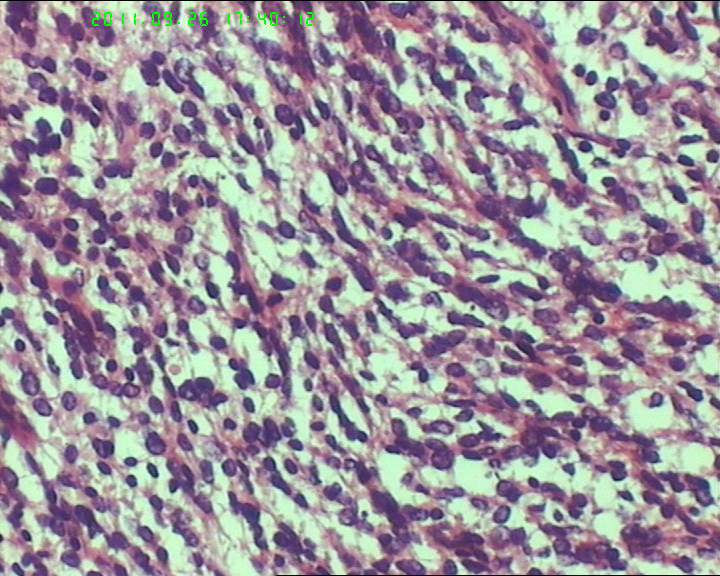 74岁女性盆腔包块，肉瘤？图14