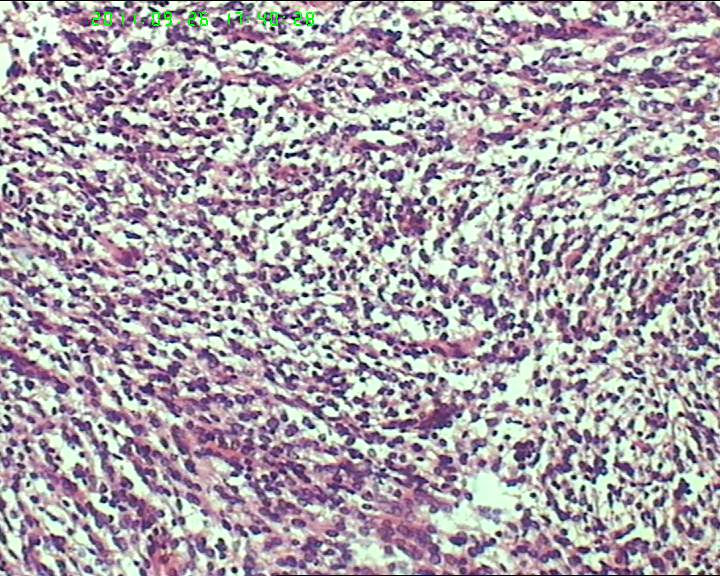 74岁女性盆腔包块，肉瘤？图15