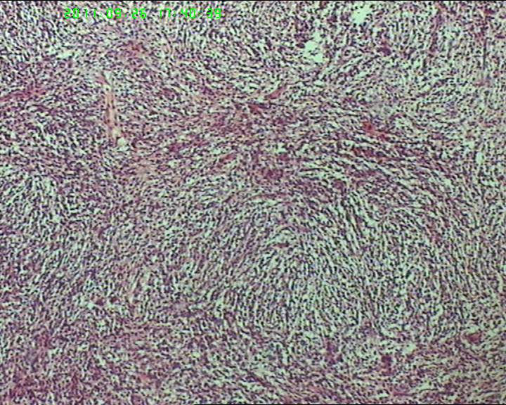 74岁女性盆腔包块，肉瘤？图16