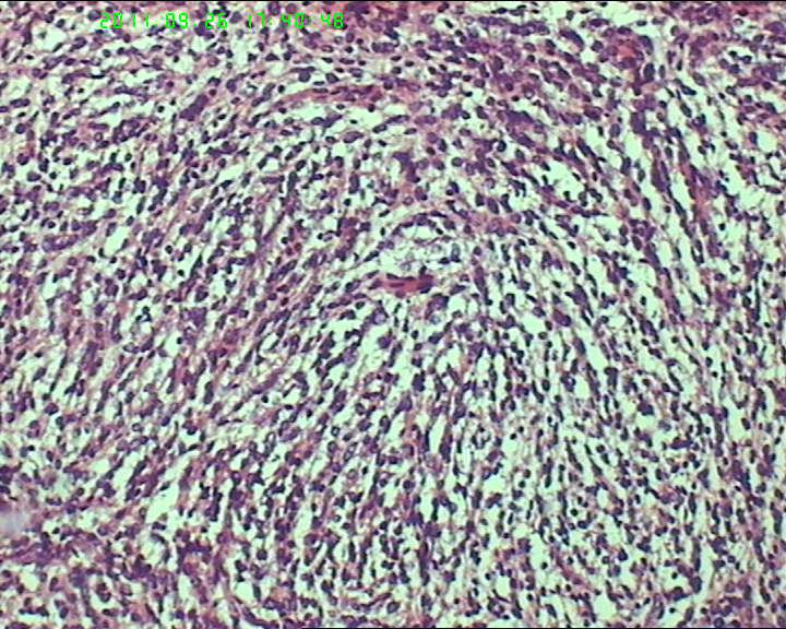 74岁女性盆腔包块，肉瘤？图17
