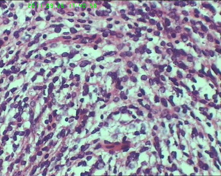 74岁女性盆腔包块，肉瘤？图18