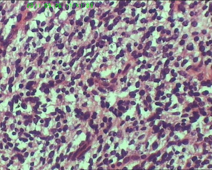 74岁女性盆腔包块，肉瘤？图19