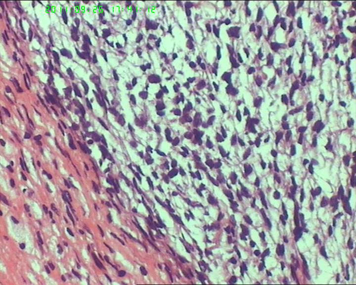 74岁女性盆腔包块，肉瘤？图20