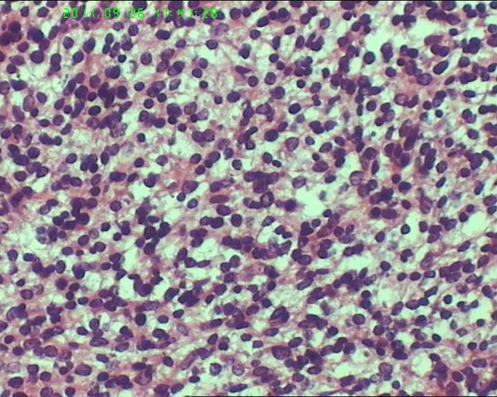 74岁女性盆腔包块，肉瘤？图21