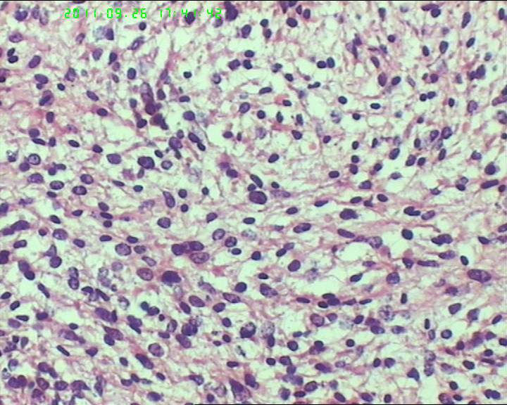 74岁女性盆腔包块，肉瘤？图22