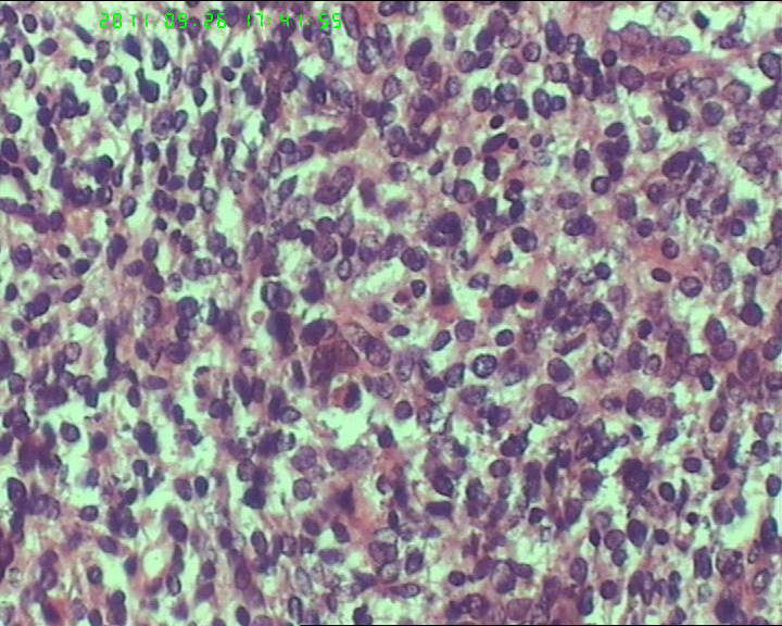 74岁女性盆腔包块，肉瘤？图23