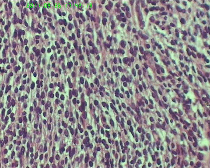 74岁女性盆腔包块，肉瘤？图24