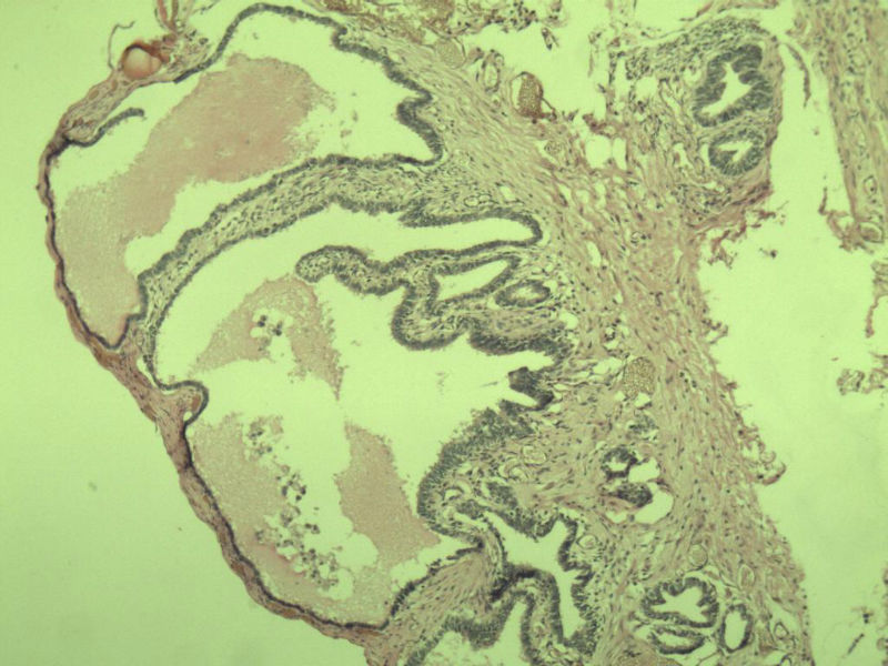 阑尾图3 阑尾图3